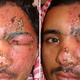 Illustration for article titled Pengobatan Penyakit Herpes Secara Tradisional